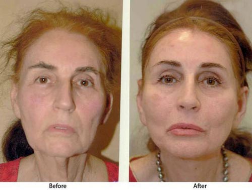 عکسهای دیدنی از قبل و بعد از عمل فیس لیفتینگ