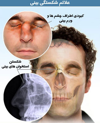 دلیل شکستگی بینی و روش درمان آن!!