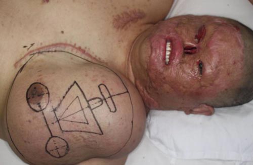 برق گرفتگی موجب رشد صورت جدید در سینه مردی شد!+عکس