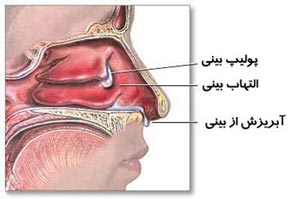 دلایل گرفتگی بینی