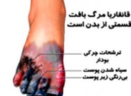 دانستنیهای بیماری قانقاریا
