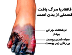 دانستنیهای بیماری قانقاریا