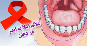 نشانه های مبتلاشدن به ایدز در دهان