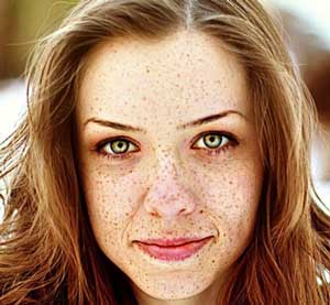 به کمک چه روشی از شر کک و مک صورت خلاص شویم؟ +عکس