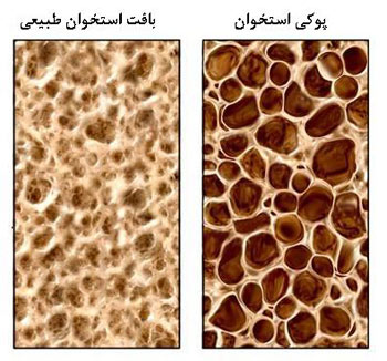 8 راه برای جلوگيری از پوكی استخوان در بانوان