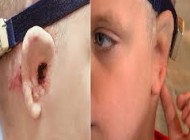 عمل خارق العاده و موفق پیوند گوش به پسری بی گوش