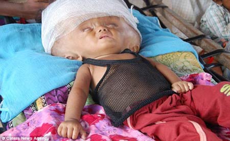 این کودک در انتظار انفجار جمجمه اش است! + تصاویر