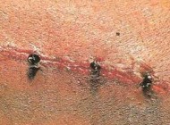 مورچه های عجیبی که بخیه جراحی میزنند +عکس