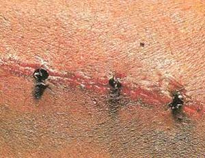 مورچه های عجیبی که بخیه جراحی میزنند +عکس