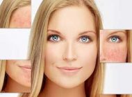 نکاتی برای مراقبت از پوست مبتلا به روزاسه