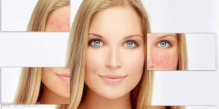 نکاتی برای مراقبت از پوست مبتلا به روزاسه