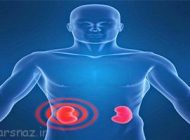 بیماری کلیوی و نشانه های آن را بهتر بشناسیم