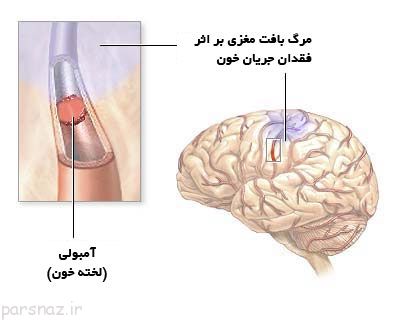 با این علایم حتما یک ماه دیگر سکته میکنید