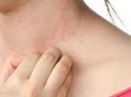 آلرژی خانوادگی چیست و چگونه با آن مقابله کنیم؟