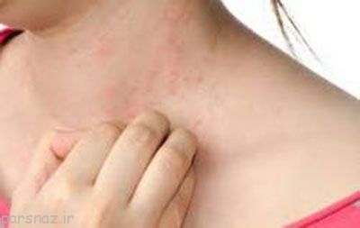 آلرژی خانوادگی چیست و چگونه با آن مقابله کنیم؟