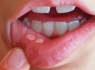 درباره آفت دهان چه میدانید؟