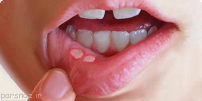 درباره آفت دهان چه میدانید؟