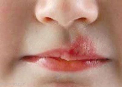 حواسمان باید به عفونت های پوستی باشد