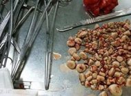 درباره سنگ مثانه بیشتر بدانیم