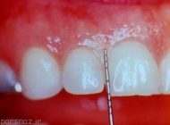 با عفونت لثه چه کنیم؟