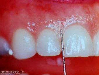 با عفونت لثه چه کنیم؟