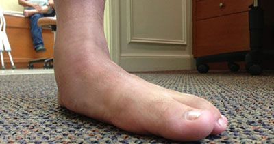درباره صافی کف پا چه می دانید؟