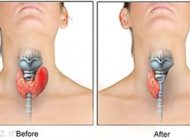برداشتن غده تیروئید و سلامت بدن