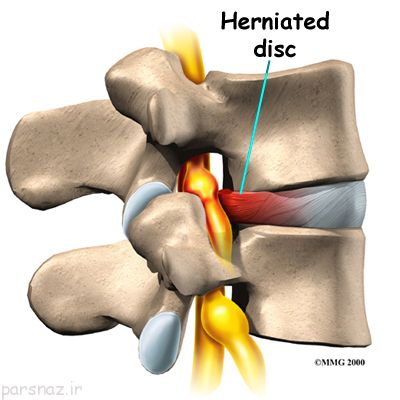 مراقبت از دیسک کمر ضروری است