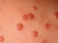 روش های مقابله با زگیل پوستی