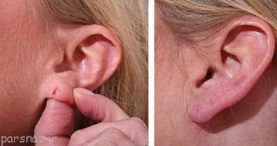 درباره جراحی زیبایی گوش چه می دانید؟