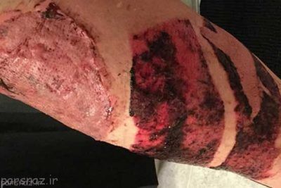 انفجار گوشی سامسونگ باعث سوختگی شد