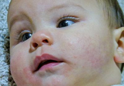 نجات کودک وقتی جسم خارجی را بلعیده