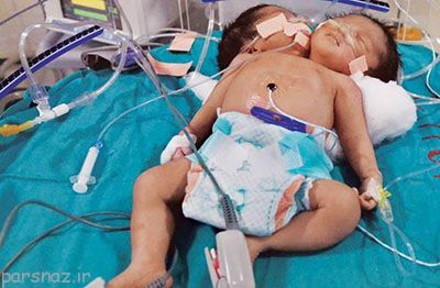 عاقبت دردناک نوزاد دوکله را ببینید