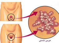 عارضه هرپس تناسلی در مردان و زنان