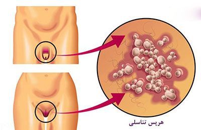 عارضه هرپس تناسلی در مردان و زنان