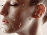 تاثیر طب سوزنی در از بین بردن جوش های صورت