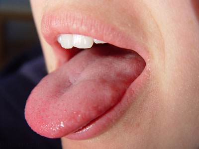 چرا گاهی دهان ما مزه فلز می گیرد؟