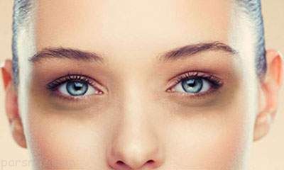 تیرگی زیر چشم را با این روش عالی رفع کنید