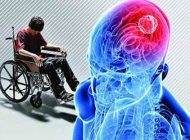نشانه های اولیه بیماری ام اس در بدن را بشناسید