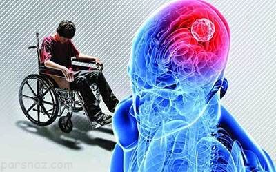نشانه های اولیه بیماری ام اس در بدن را بشناسید