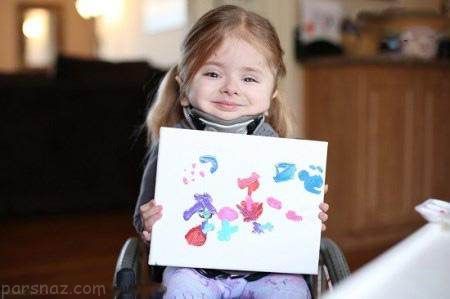 همه استخوان های بدن این دختر شکسته است