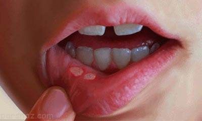 بهبود آفت دهان با استفاده از طب سنتی