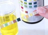 دلایل شایع تغییر رنگ ادرار را بدانید