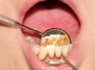 بهترین روش رفع پلاک دندان در 5 دقیقه