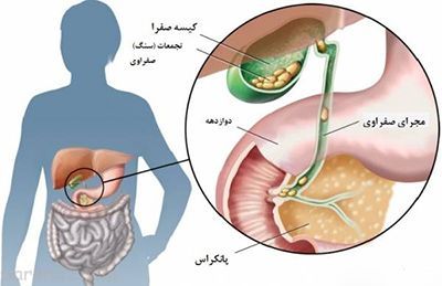 این غذاها برای کیسه صفرا بسیار مضر هستند