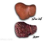 نشانه های اولیه بیماری نارسایی کبد را بشناسید
