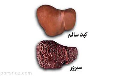نشانه های اولیه بیماری نارسایی کبد را بشناسید