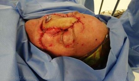 داستان وحشتناک مردی که خرس صورتش را خورد +عکس