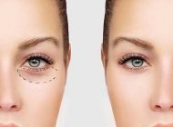 همه چیز درباره انجام جراحی زیبایی پلک خانم ها