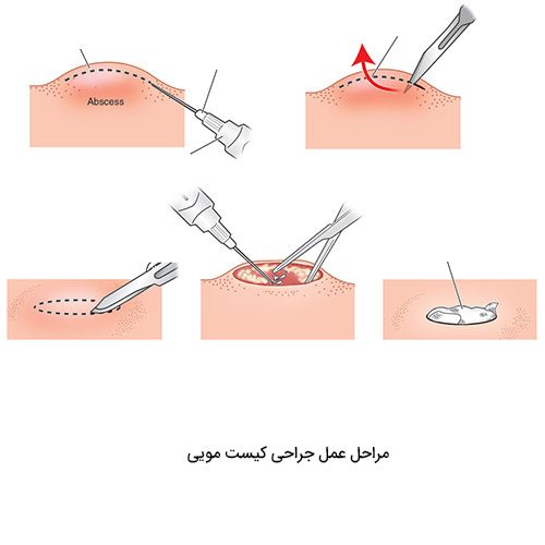 با استفاده از لیزر درمان کیست مویی دیگر هولناک نیست